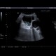 Cholecystolithiasis with sludge: US - Ultrasound